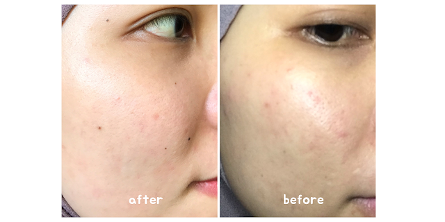 hasil pemakaian ebright skin matcha o'cica soothing cream review eBright Skin Matcha O'Cica Soothing Cream, review Niacinamide 4% + Turmenic + Propolis Advanced Luminous Cream, review daily cream ebright skin, harga ebright skin, review ebright skin, review skincare ibu menyusui, review skincare aman ibu hamil dan menyusui, review skincare aman ibu menyusui, review skincare ibu hamil, hasil pemakaian eBright Skin Matcha O'Cica Soothing Cream, hasil pemakaian Niacinamide 4% + Turmenic + Propolis Advanced Luminous Cream