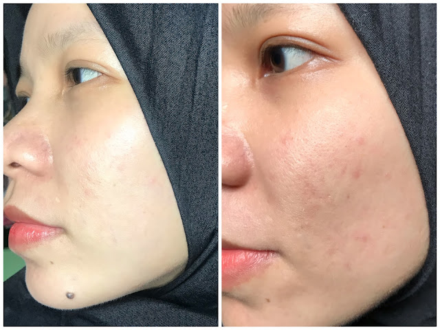 review elsheskin radiant skin serum, packaging elsheskin, tekstur serum elsheskin, elsheskin radiant skin serum, review elsheskin radiant skin serum, review elsheskin, review elsheskin radiant serum, review serum elsheskin, review elsheskin, serum untuk kulit kering, serum untuk kulit kusam, serum pencerah kulit wajah, review serum pencerah kulit wajah review elsheskin radiant skin serum