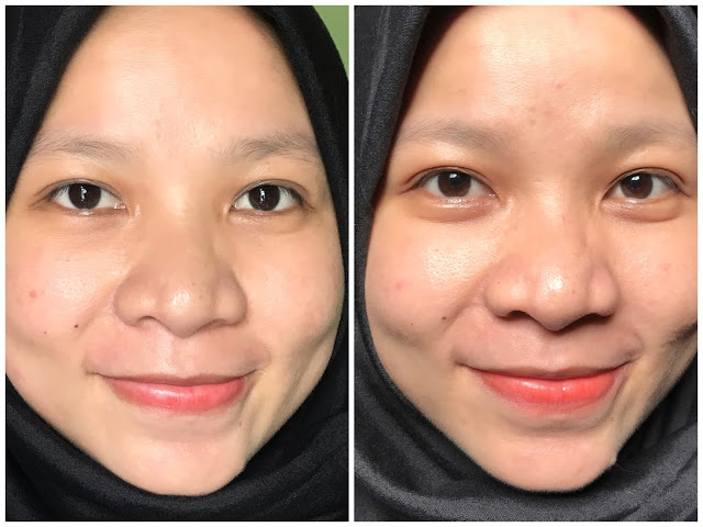 rekomendasi serum untuk jerawat dan bekasnya